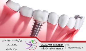 آموزش ایمپلنت