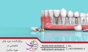 ایمپلنت دندان