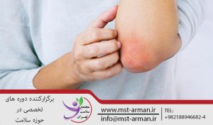 درمان اگزما