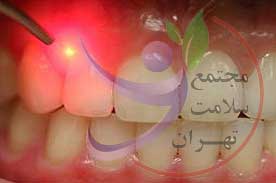 لیزر دندان | مجتمع سلامت تهران