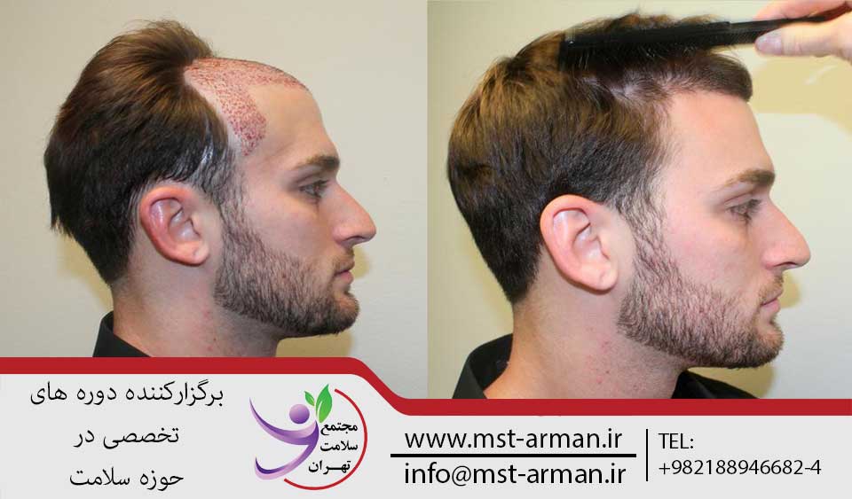 کاشت موی طبیعی | مجتمع سلامت تهران